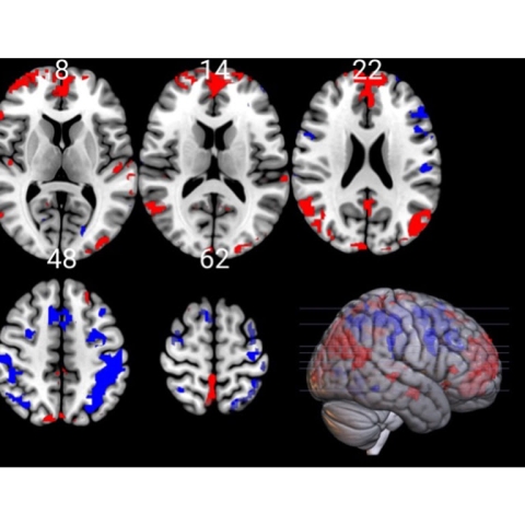 Layers of the MRI scan also showing increased activity in the medial prefrontal cortex and parietal cortex