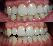 Side by side images of teeth before and after Gingivitis